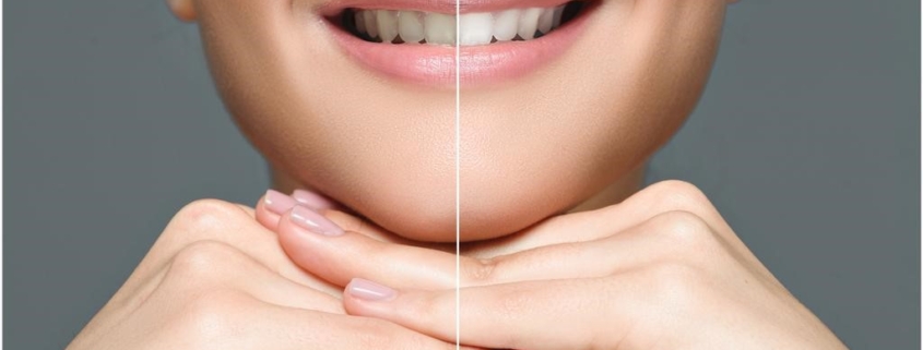 Teeth Whitening Newcastle