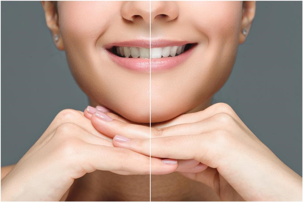 Teeth Whitening Newcastle