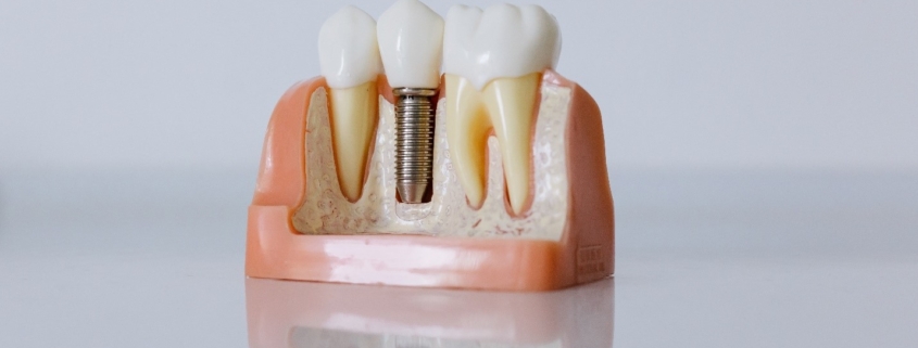 Dental Implant Newcastle