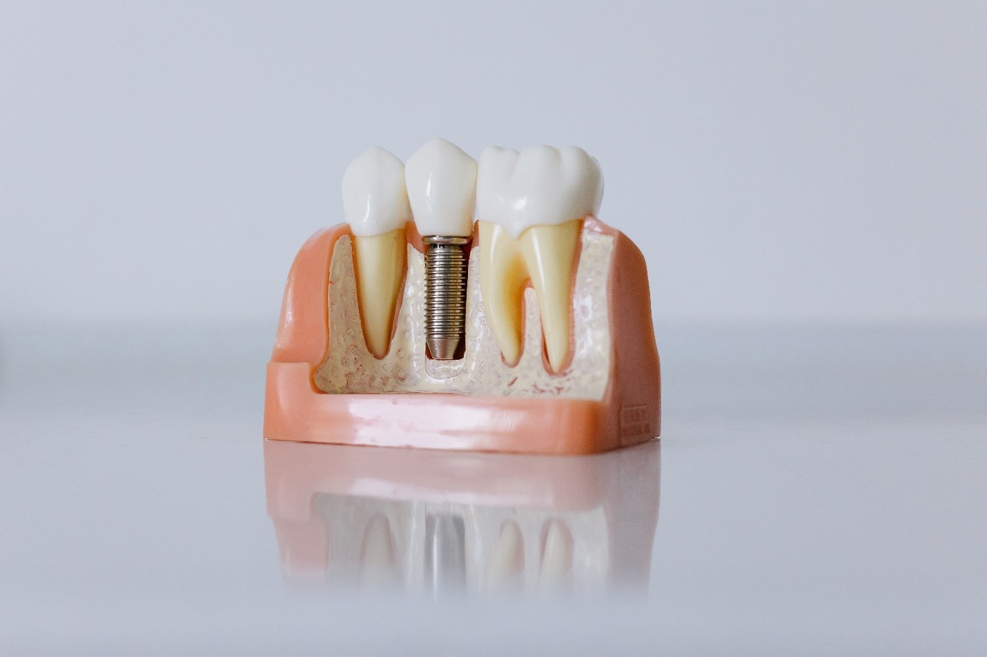 Dental Implant Newcastle