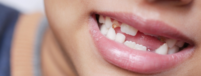 Replacing Missing Teeth