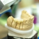 Dental Implant Newcastle