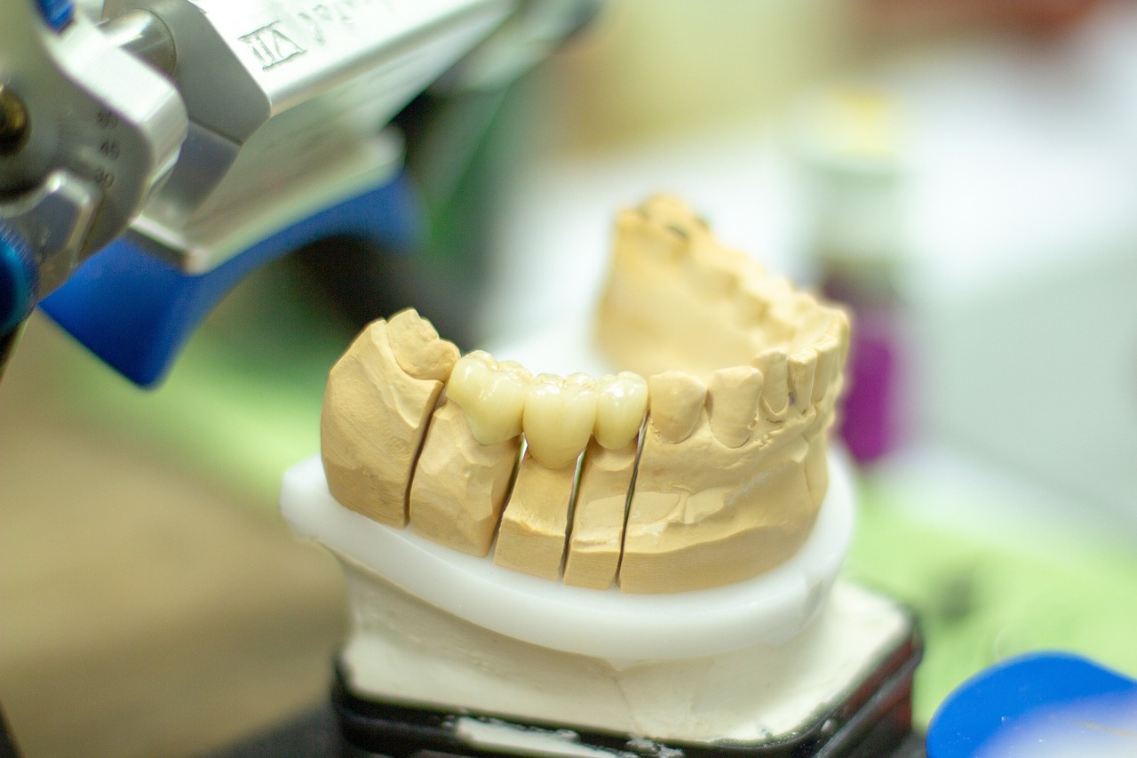 Dental Implant Newcastle