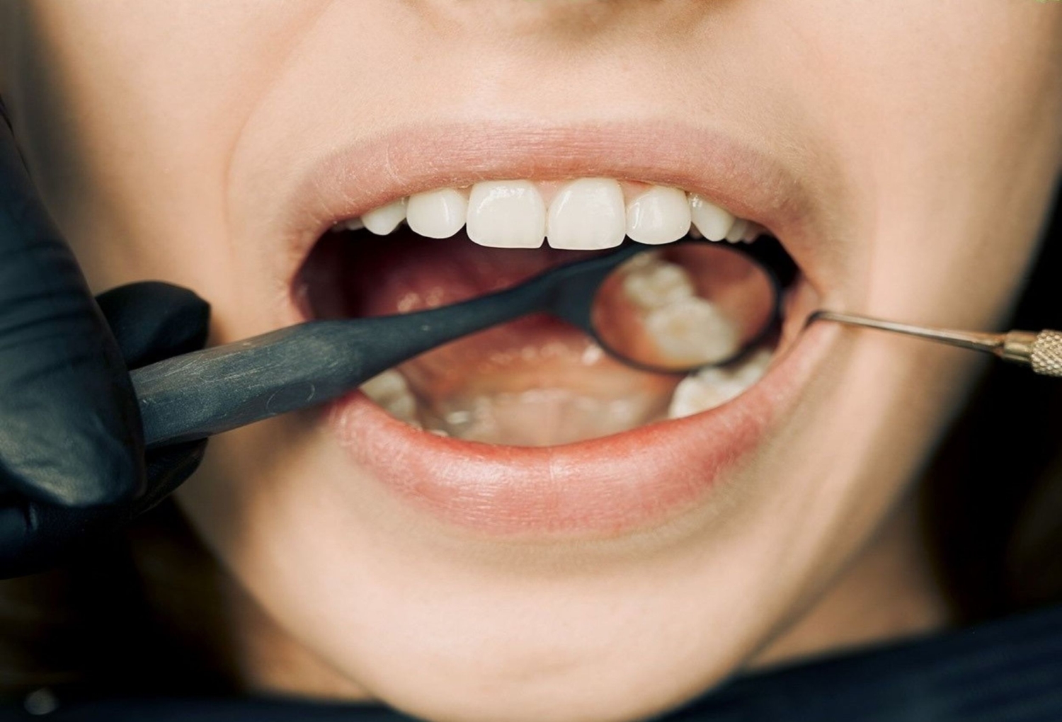 Teeth Whitening Newcastle
