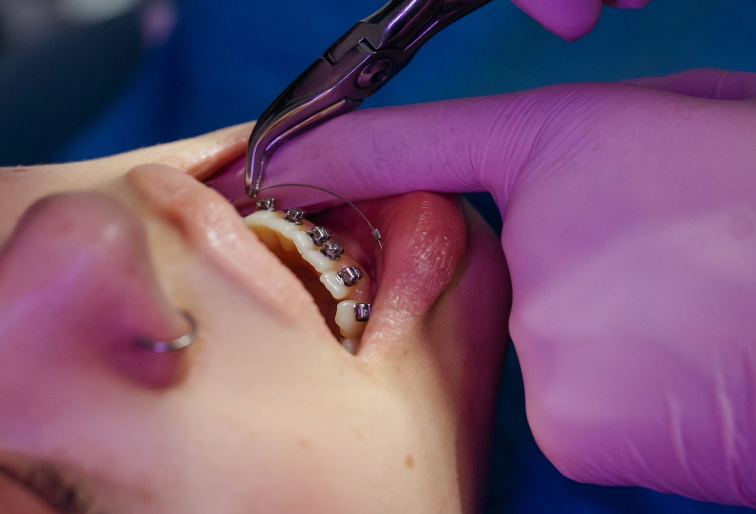 Orthodontic Treatment Newcastle