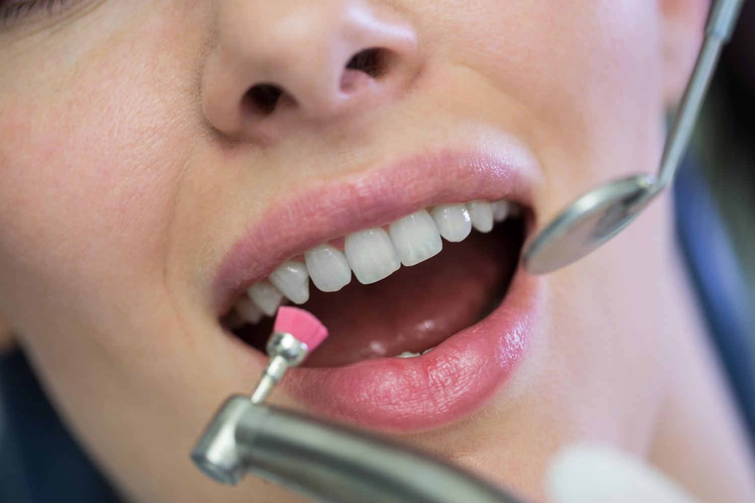 Teeth Whitening Newcastle