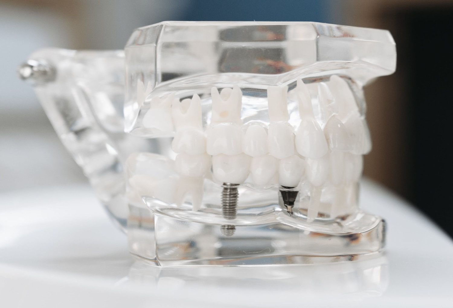 Dental Implants Newcastle