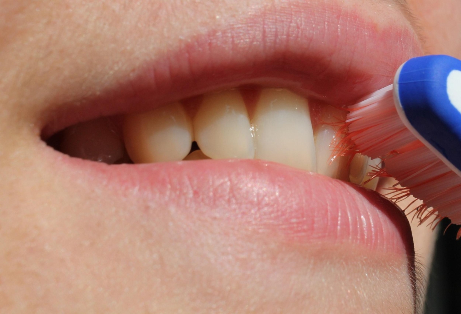 The Best Teeth Whitening Treatments in Newcastle