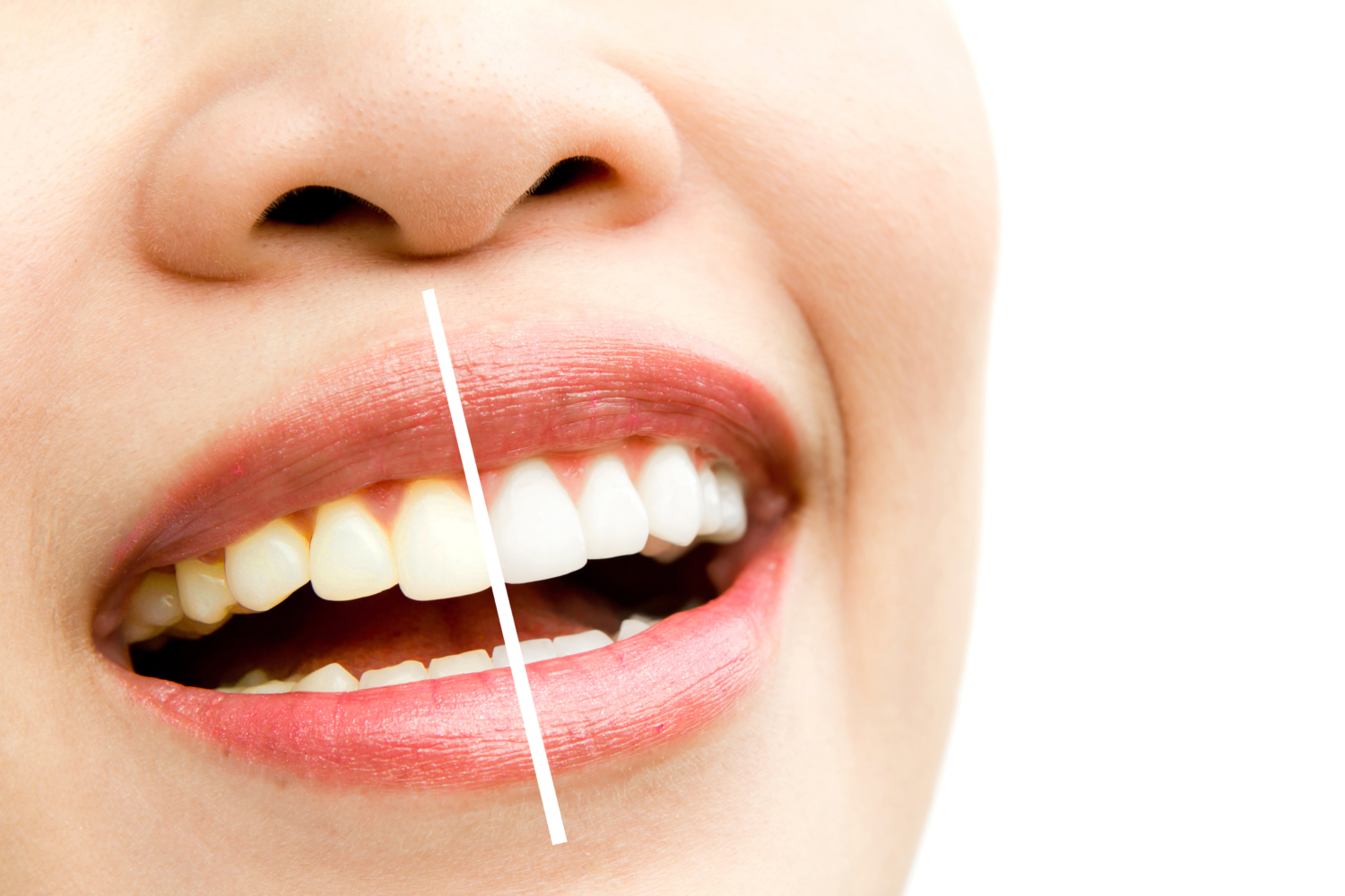 How a teeth-whitening dentist in Newcastle can help you