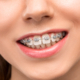 Orthodontic Braces Newcastle