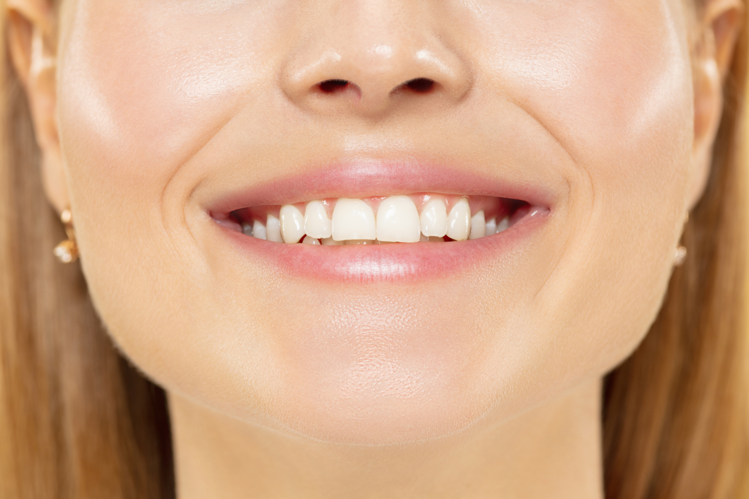 Teeth Whitening Newcastle