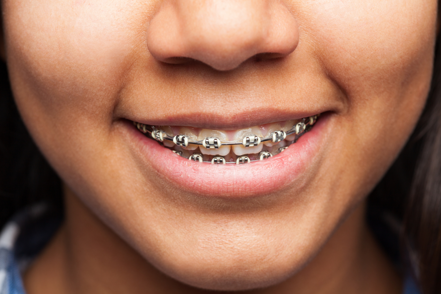 Orthodontics Braces Newcastle