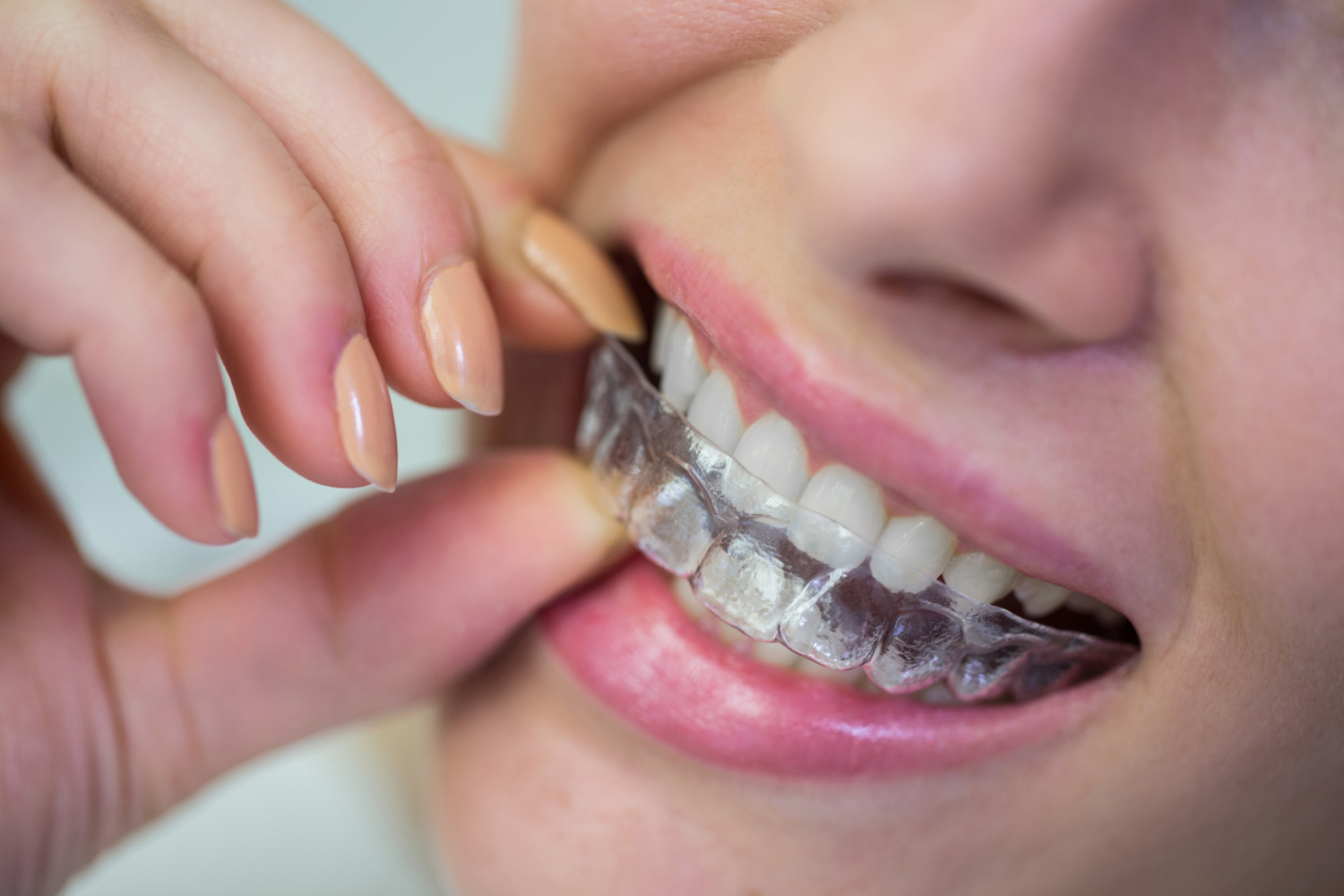 Invisalign Newcastle How Invisalign Can Transform Your Teeth Without Noticing By Anyone - The Dental Care Clinic - Dentist Orthodontics Teeth Whitening in Newcastle Upon Tyne - North East