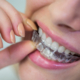 Invisalign Newcastle How Invisalign Can Transform Your Teeth Without Noticing By Anyone - The Dental Care Clinic - Dentist Orthodontics Teeth Whitening in Newcastle Upon Tyne - North East