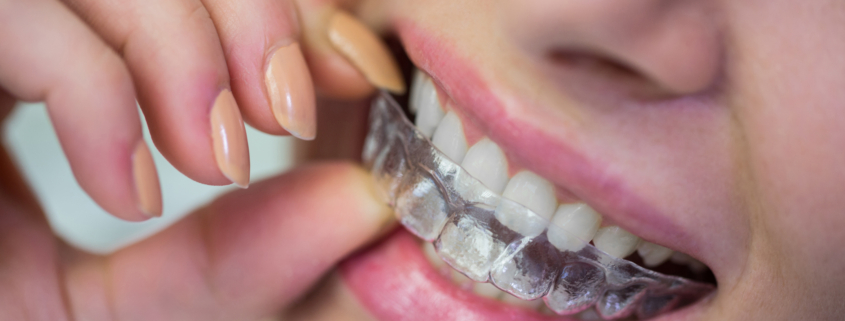 Invisalign Newcastle How Invisalign Can Transform Your Teeth Without Noticing By Anyone - The Dental Care Clinic - Dentist Orthodontics Teeth Whitening in Newcastle Upon Tyne - North East
