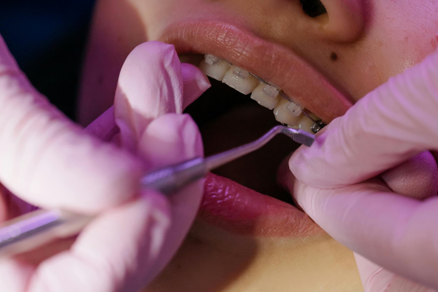 Orthodontics Braces Newcastle: How Do I Know If I Need Orthodontics Treatment?The Dental Care Clinic - Dentist Orthodontics Teeth Whitening in Newcastle Upon Tyne - North East
