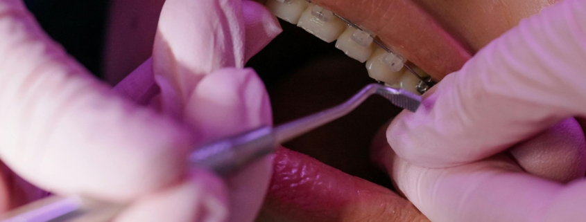 Orthodontics Braces Newcastle: How Do I Know If I Need Orthodontics Treatment?The Dental Care Clinic - Dentist Orthodontics Teeth Whitening in Newcastle Upon Tyne - North East