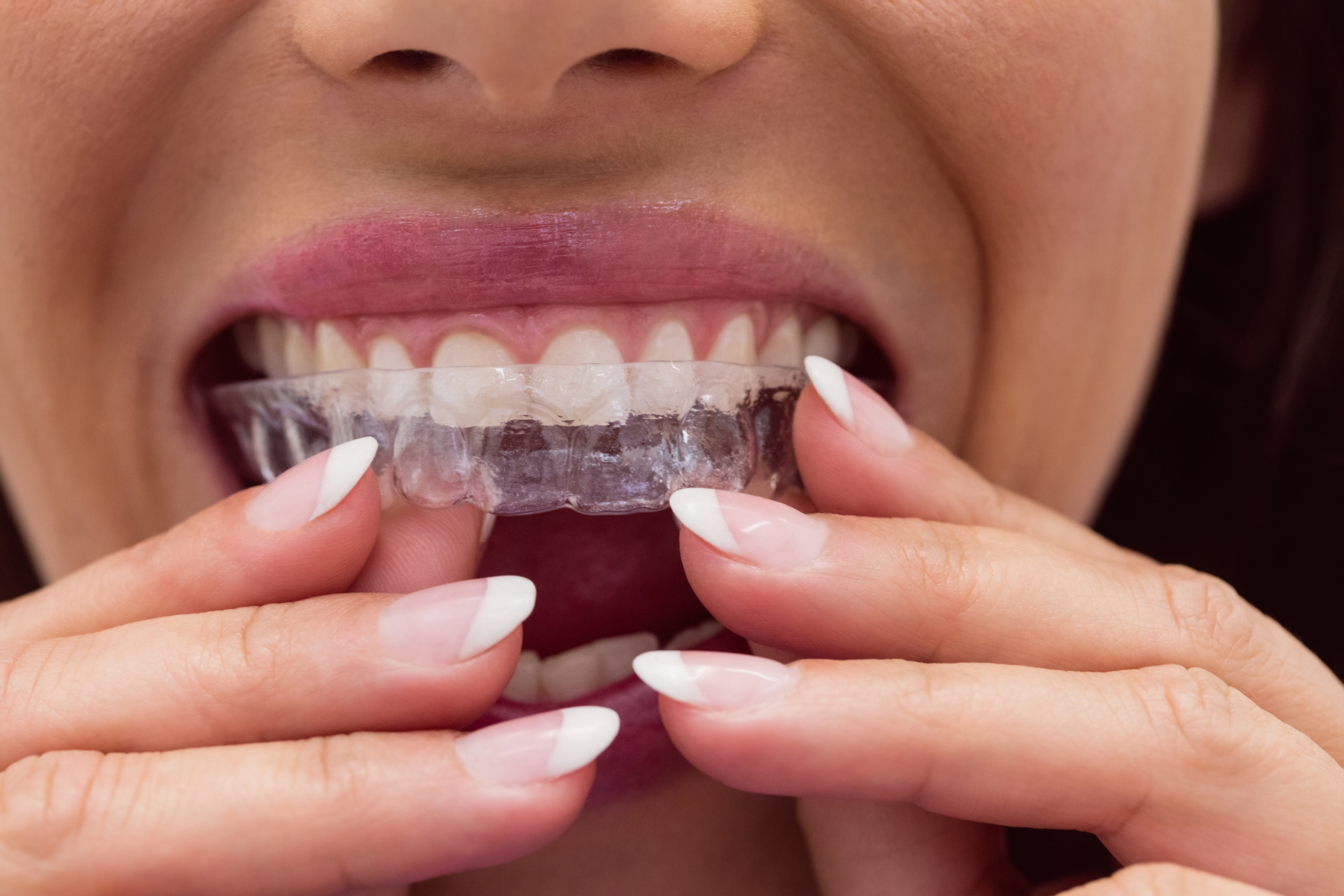 Clear Aligners or Clear Braces? The Top Choices for Patients in Newcastle The Dental Care Clinic - Dentist Orthodontics Teeth Whitening in Newcastle Upon Tyne - North East