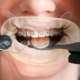 Orthodontics in Newcastle: Achieve the Perfect Smile with Clear Braces - Dentist Orthodontics Teeth Whitening in Newcastle Upon Tyne - North East