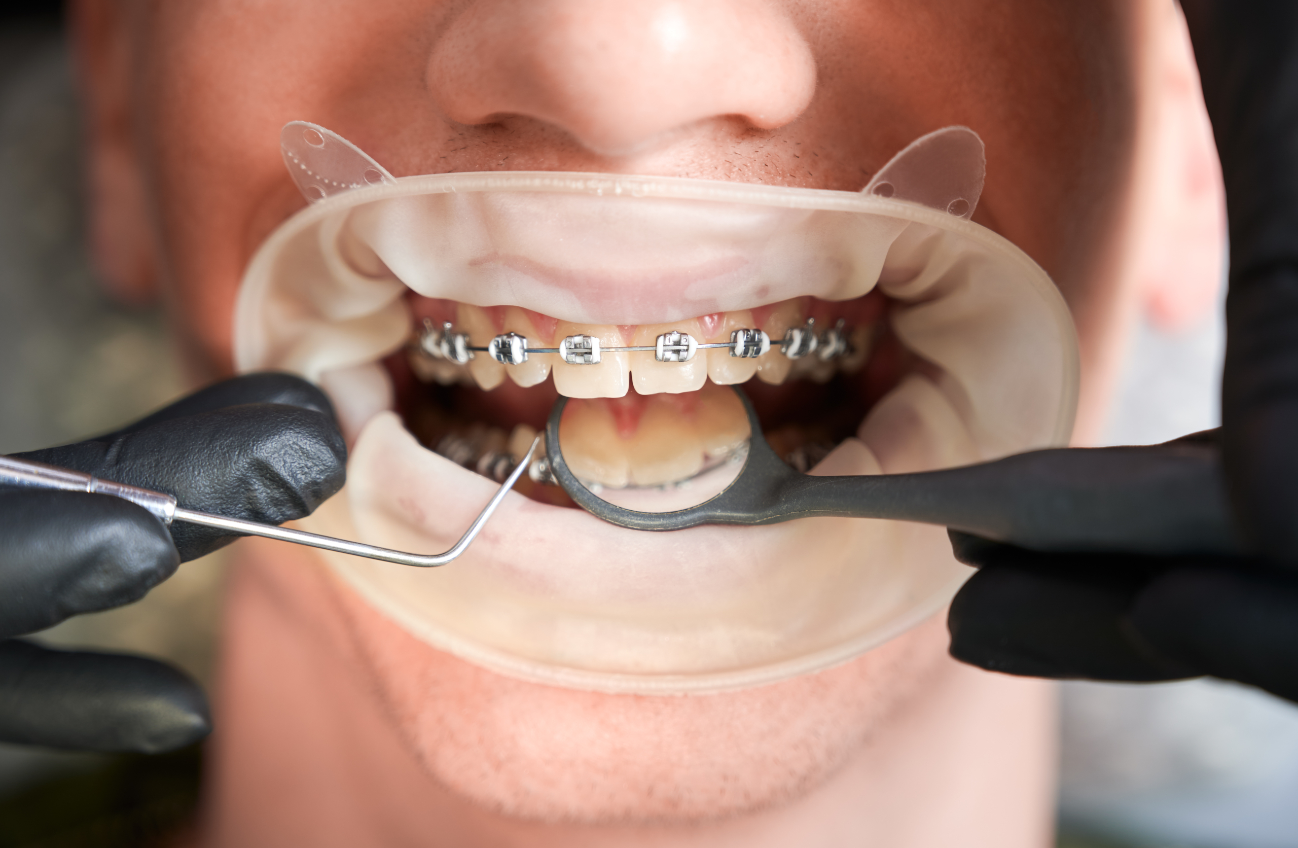 Orthodontics in Newcastle: Achieve the Perfect Smile with Clear Braces - Dentist Orthodontics Teeth Whitening in Newcastle Upon Tyne - North East