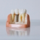 Dental Implant West Jesmond - Teeth Implant in West Jesmond